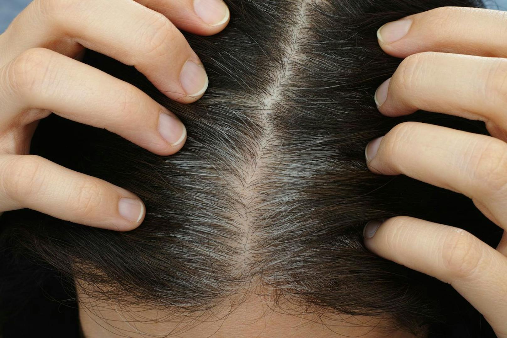 Wenn Melanozyten-Stammzellen aufhören, sich zwischen den Wachstumsphasen in den Haarfollikeln zu bewegen, produzieren sie kein Pigment mehr. Die Folge: Die Haare ergrauen.