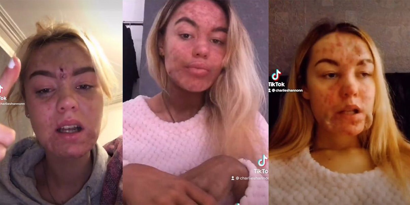 Charlie-Shannon Bedford (Bild) nutzt ihre Erfahrung heute, um andere auf TikTok über Essstörungen aufzuklären.