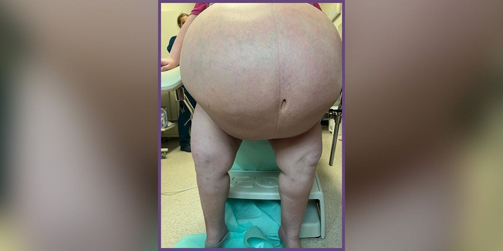 Das von der Universitätsklinik Rzeszow zur Verfügung gestellte Bild zeigt die Frau mit der 100-Kilo-Zyste.