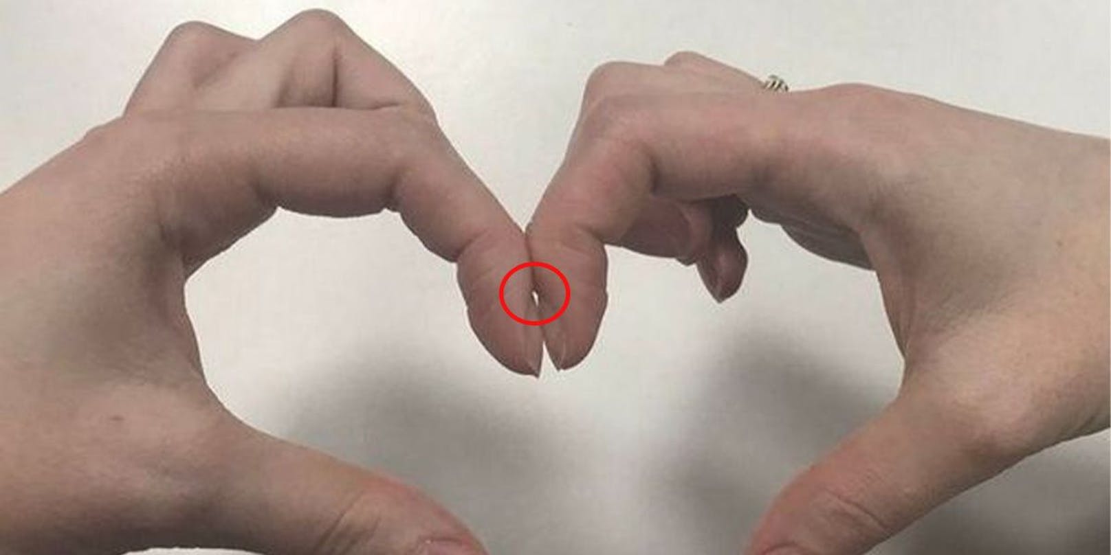 Bildet sich ein kleiner Spalt, wenn du die gleichen Finger jeder Hand so zusammenlegst, ist alles in Ordnung. Besteht der Spalt nicht, können Fingerschwellungen ein erster Hinweis sein, dass eine Erkrankung vorliegt.