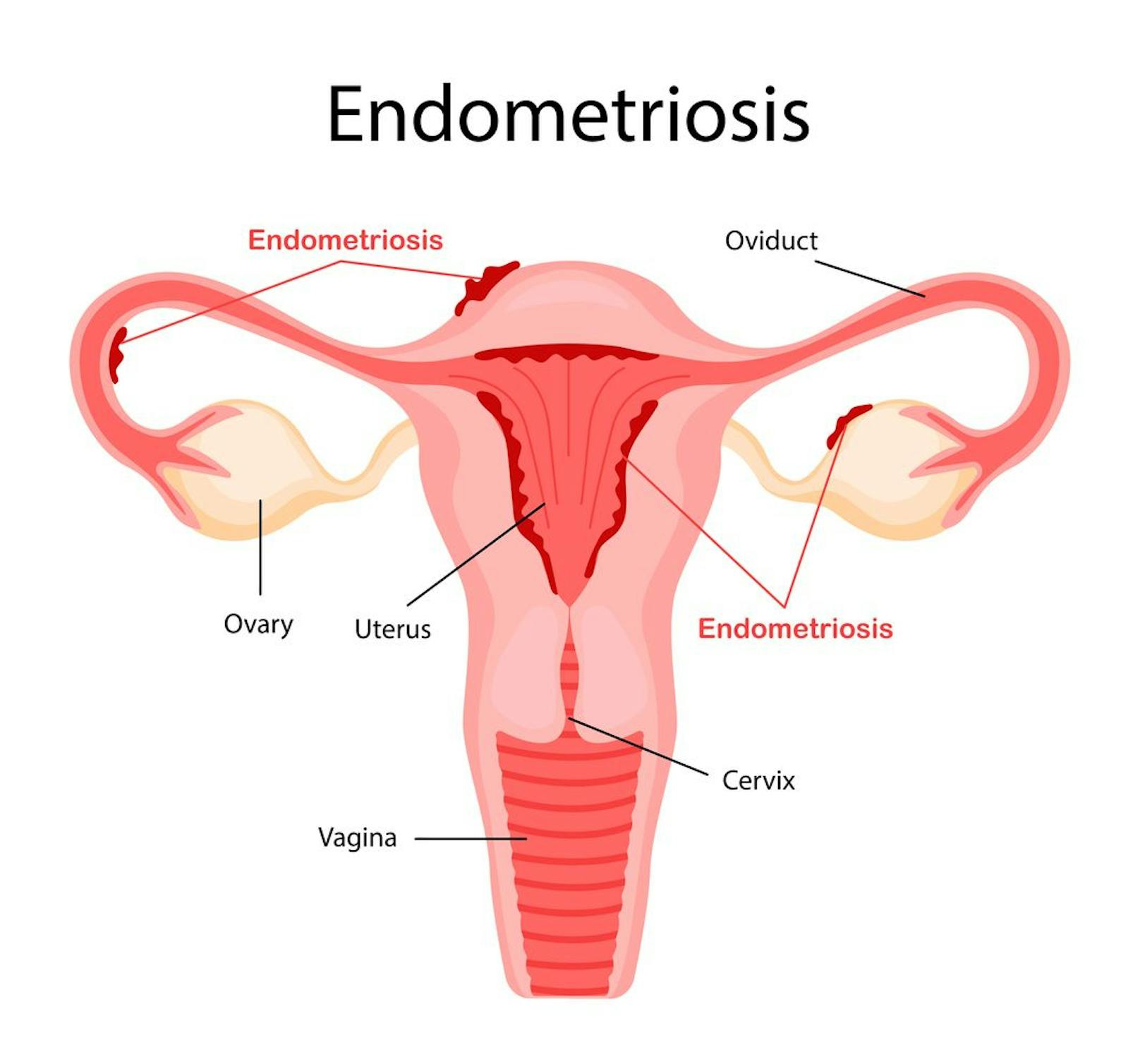 Bei der<strong> Endometriose</strong> siedelt sich Gebärmutterschleimhaut, die sich normalerweise ausschließlich in der Gebärmutter befindet, auch außerhalb davon an – etwa auf den Eierstöcken, in der Blase oder im Darm.&nbsp;