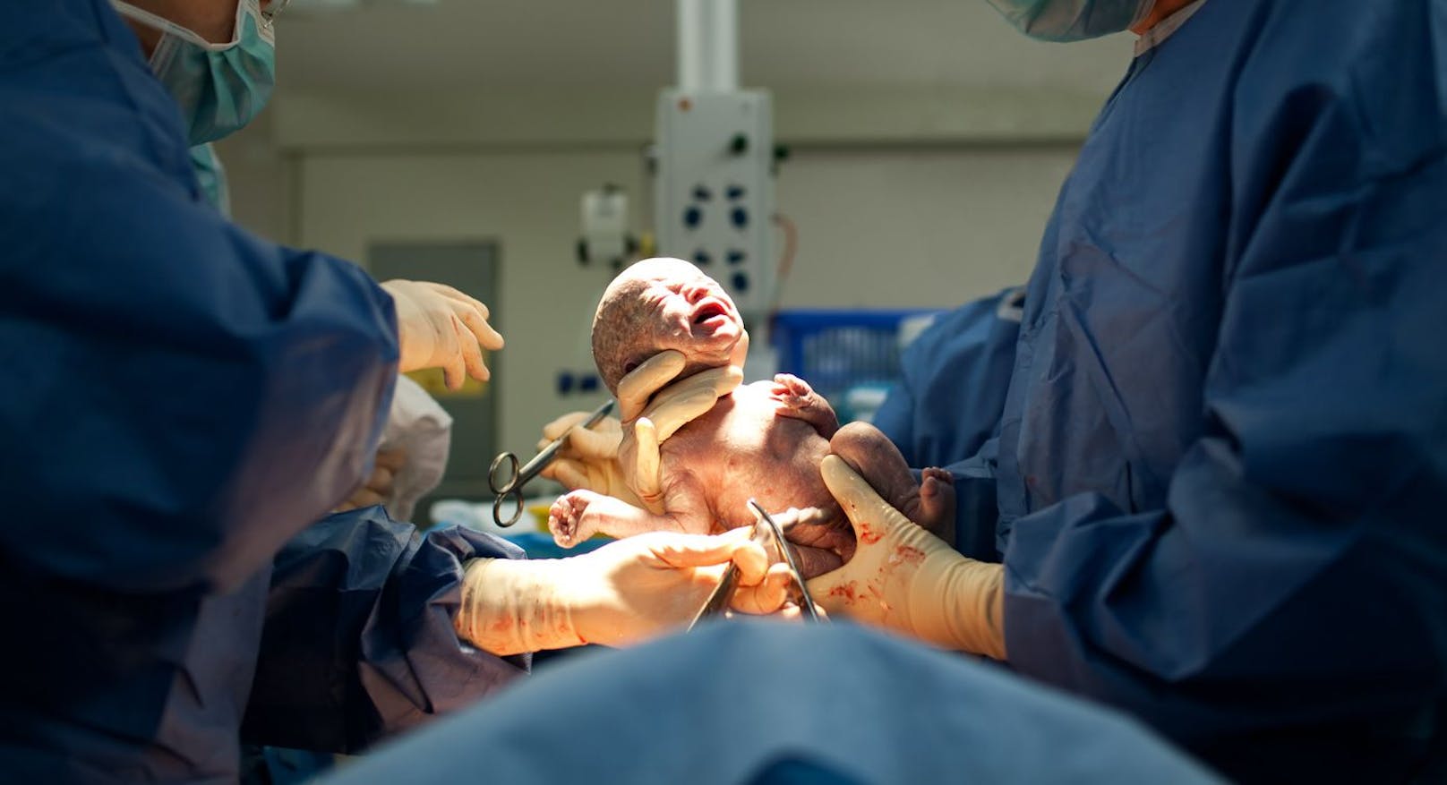 Beim Kaiserschnitt wollten die Ärzte das Baby möglichst schnell aus dem Mutterleib holen und zogen am Kopf. (Symbolbild).