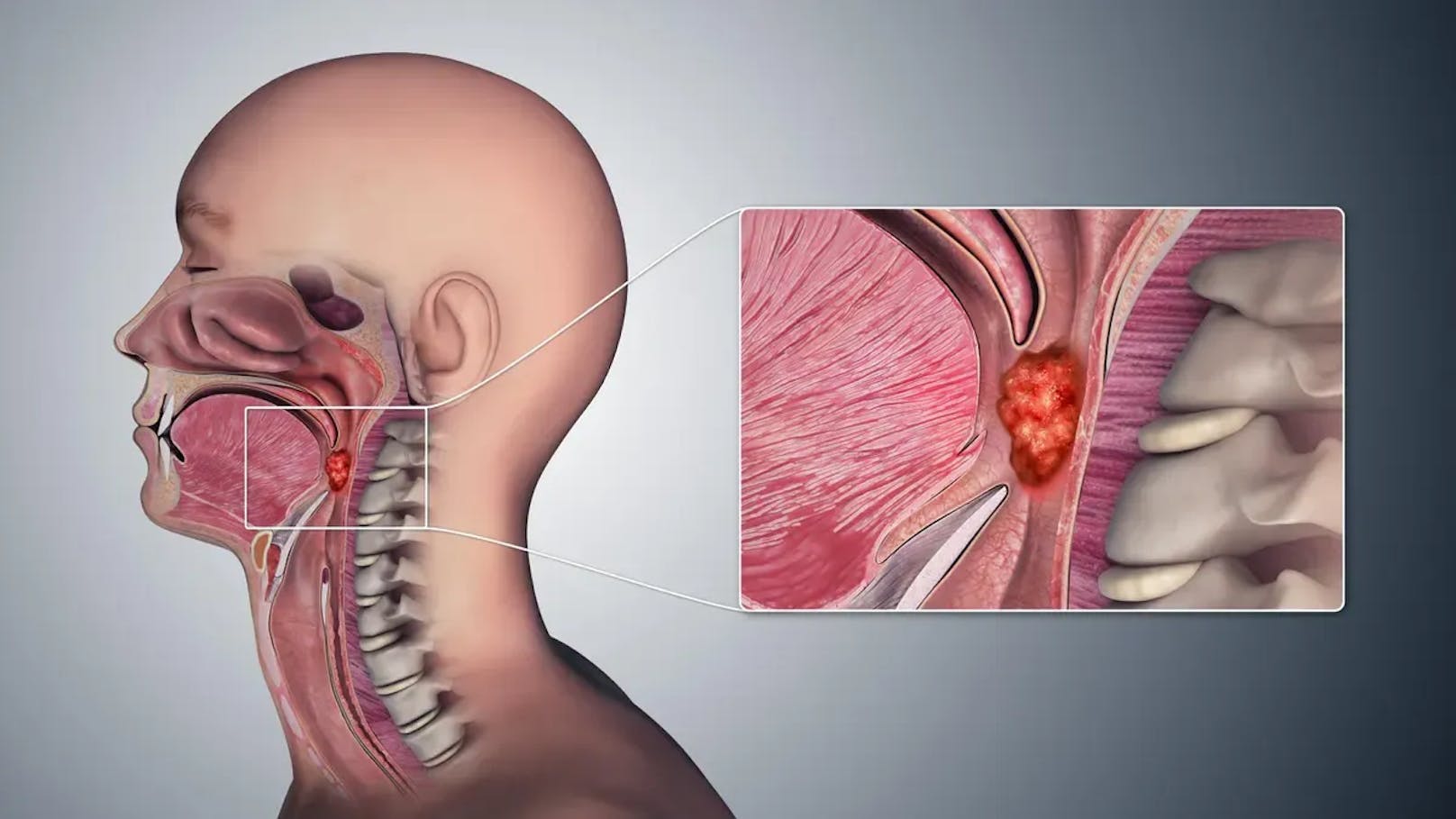 Der Anstieg betreffe vor allem Fälle von sogenannten Oropharynxkrebs, bei dem die Mandeln und der Rachen betroffen sind. (Im Bild: Medizinische 3D-Animation, die die Krebsbildung in den Geweben des Oropharynx zeigt.)