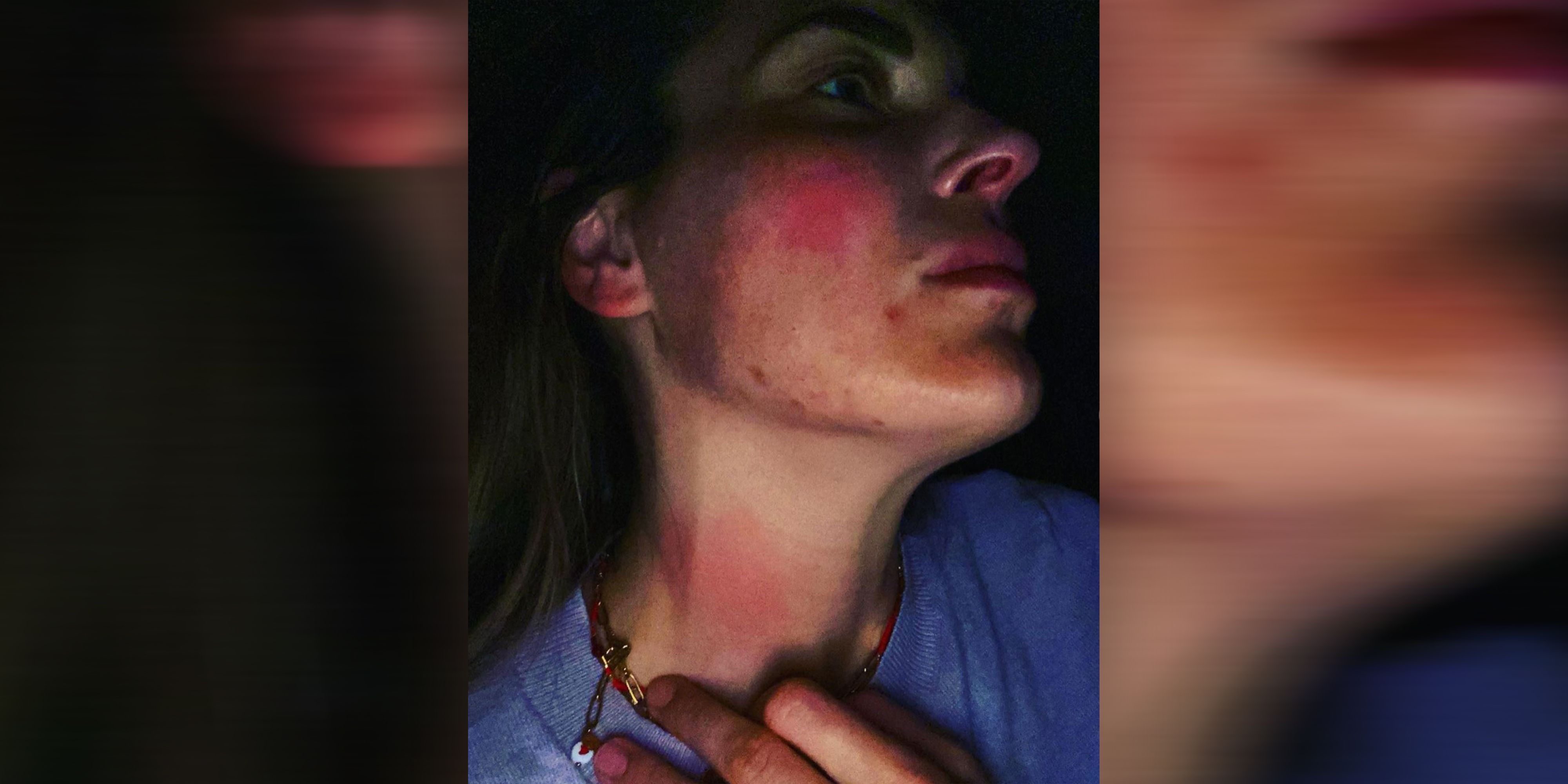 Elke Rock zeigt ihre schrecklichen Verletzungen.