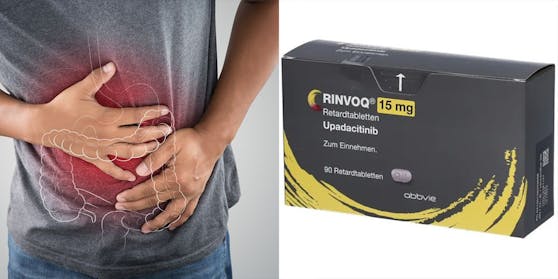 Rinvoq (Bild) ist bereits von der FDA für die Behandlung von sechs anderen immunbezogenen Erkrankungen zugelassen, darunter rheumatoide Arthritis, atopische Dermatitis und Colitis ulcerosa.