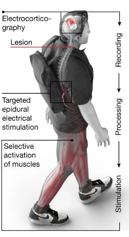Zwei Hirnimplantate mit 64 Elektroden werden epidural über dem sensomotorischen Kortex angebracht, um Elektrokortikografie<a href="https://www.pschyrembel.de/Elektrokortikografie/K06NH"></a>-Signale zu erfassen. Eine Verarbeitungseinheit sagt motorische Absichten voraus und setzt diese elektrische Stimulation um, die auf das Rückenmark abzielen. Die Stimulation erfolgt über einen implantierbaren Impulsgenerator, der mit einer 16-Elektroden-Paddle-Leitung verbunden ist.