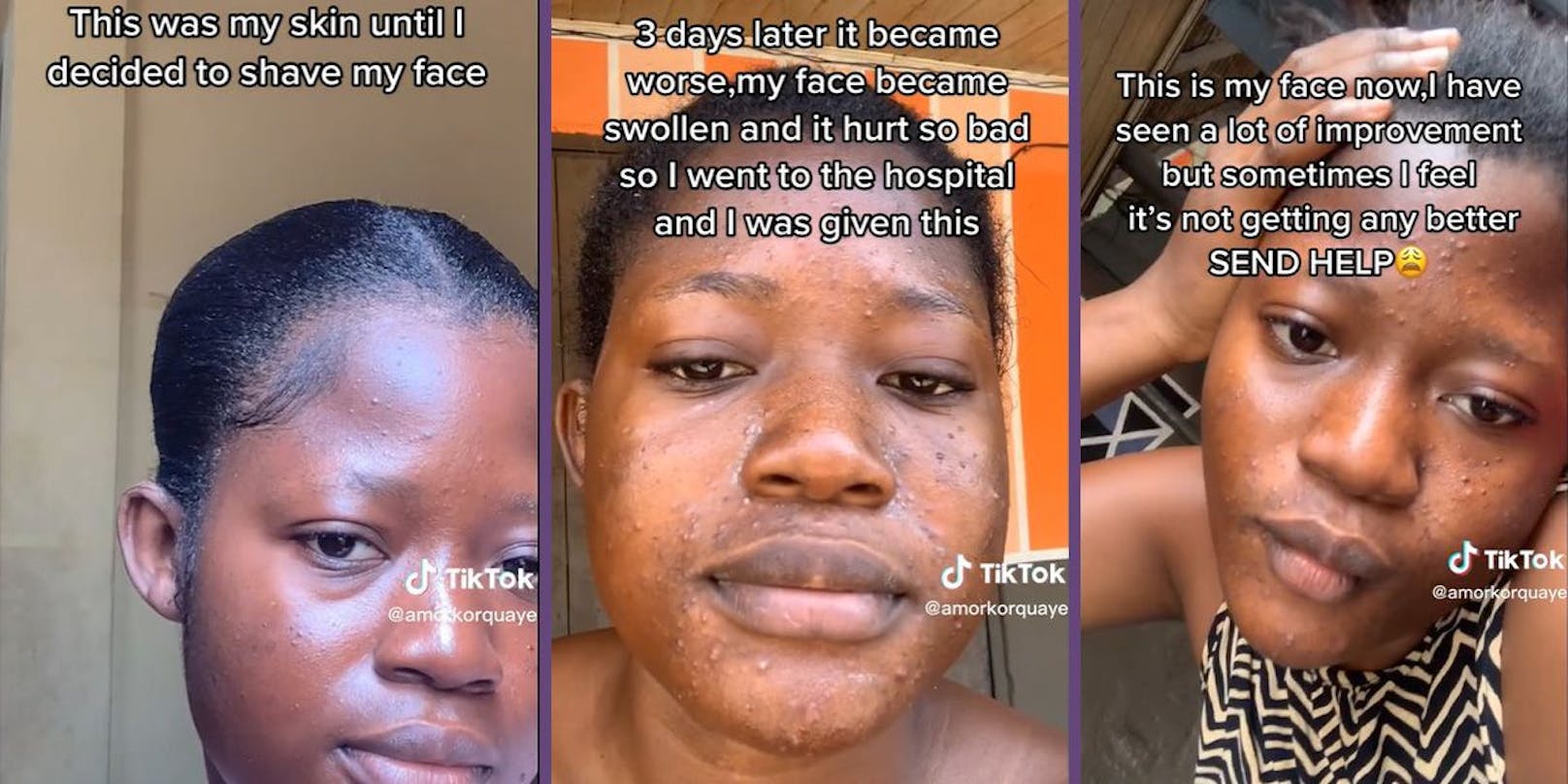Regina Quaye aus Ghana (Bild) wollte den Pfirsichflaum aus ihrem Gesicht entfernen. Ein Akneausbruch und Schwellungen waren die Folge.&nbsp;