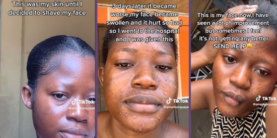 Regina Quaye aus Ghana (Bild) wollte den Pfirsichflaum aus ihrem Gesicht entfernen. Ein Akneausbruch und Schwellungen waren die Folge.&nbsp;