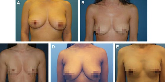 Repräsentative Bilder der 5 Patientinnen mit den höchsten durchschnittlichen Umfragewerten für die subjektive "Brustattraktivität". A-E: Die Fotos sind vom höchsten zum niedrigsten Durchschnittswert geordnet.