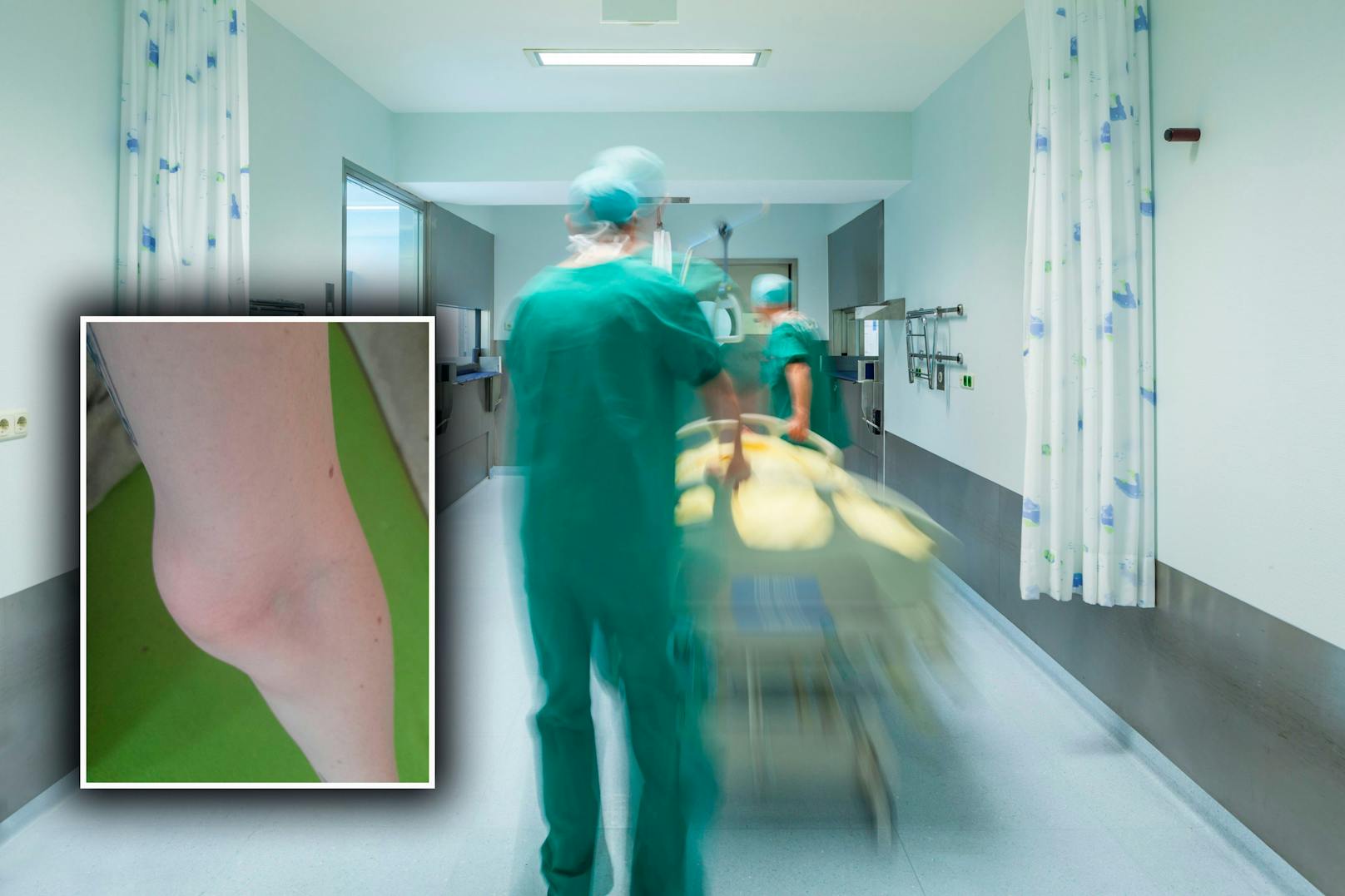 Tumor am Arm: Wienerin wartet seit Wochen auf Operation