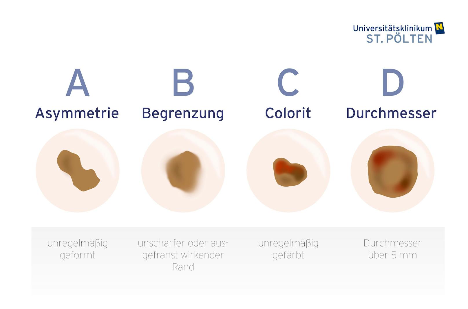 So erkennst du, ob dein Muttermal melanomverdächtig ist.