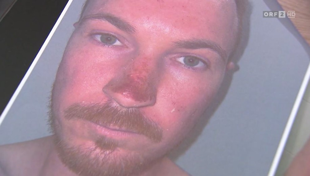 Massive Verbrennungen in der Sonne: Patrick M. leidet an der 