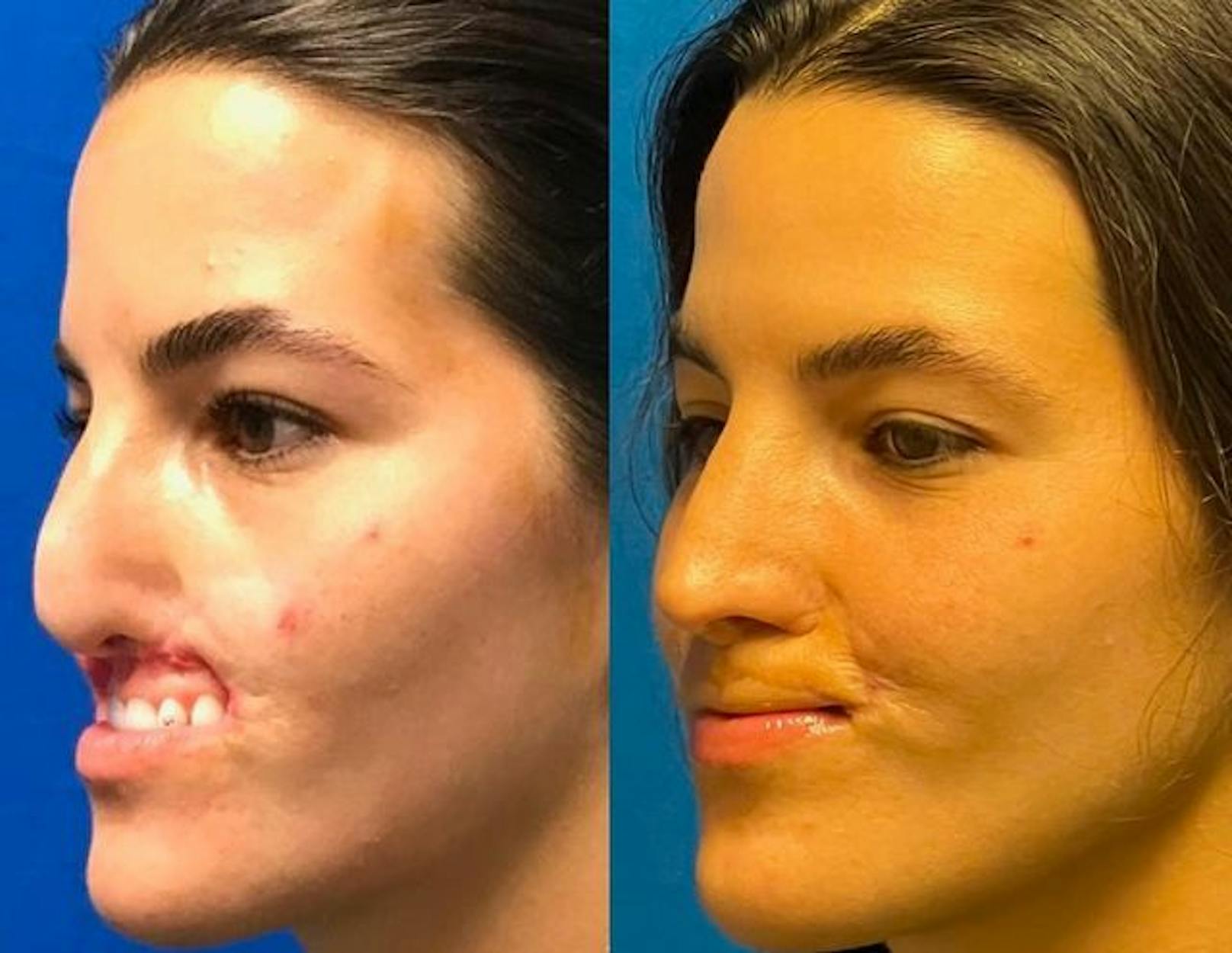Nach Pitbull-Attacke wurde ihr Gesicht neu konstruiert