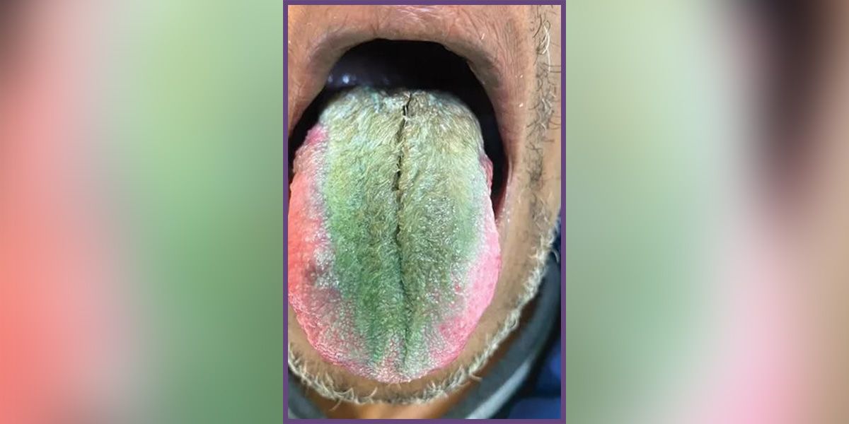 Die Ärzte diagnostizierten bei dem Patienten eine so genannte 