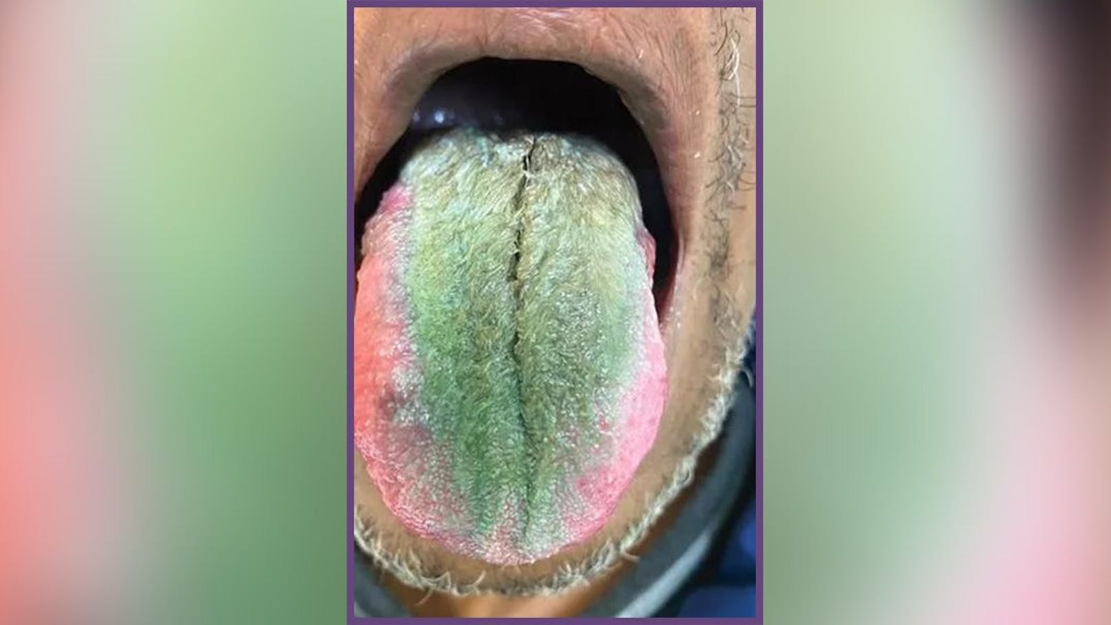 Die Ärzte diagnostizierten bei dem Patienten eine so genannte "haarige Zunge" (Bild) – einen "anormalen Belag" aus Hautzellen, der sich auf der Oberseite der Zunge bildet, wenn sich winzigen Ausstülpungen, die die Geschmacksknospen enthalten, aufgrund einer Ansammlung von Ablagerungen und Bakterien vergrößern und verfärbt haben.