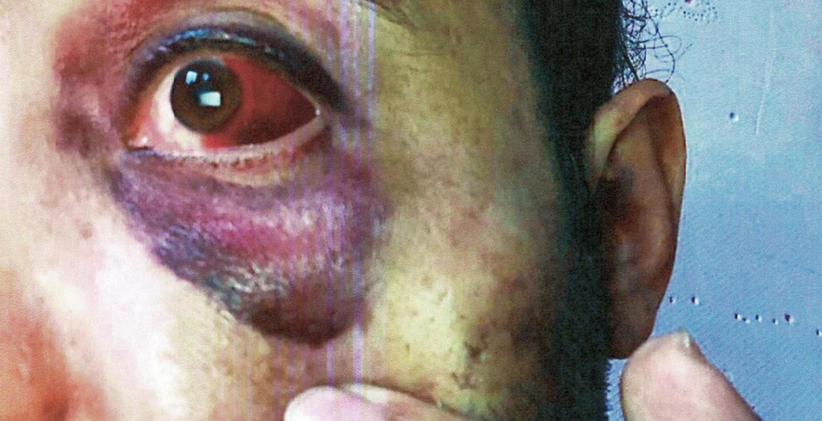 Der Syrer trug Verletzungen an der linken Gesichtshälfte davon.