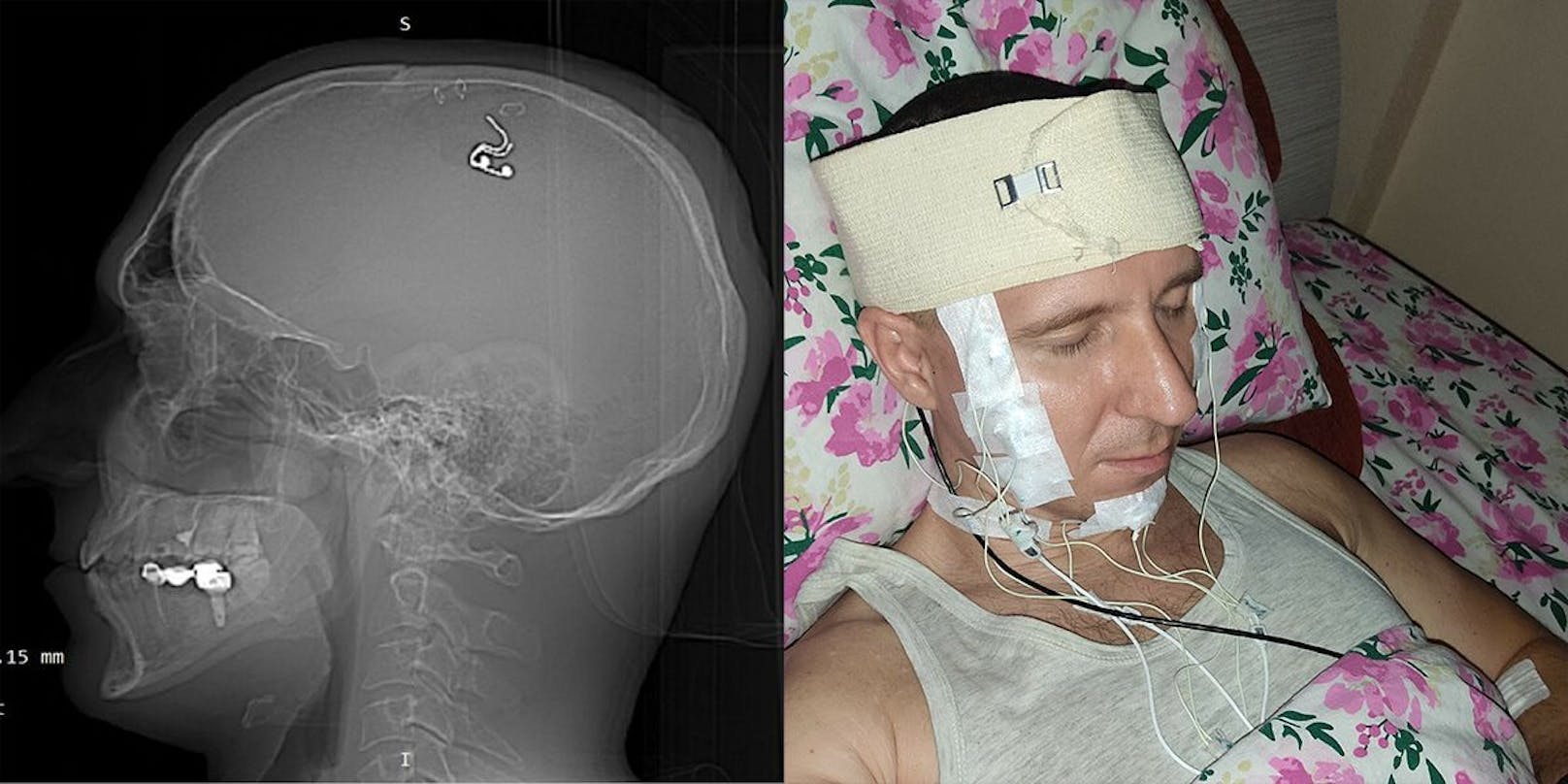 Das Röntgenbild beweist: Die Elektrode ist drin. Von dem Eingriff ist schärfstens abzuraten. Ob Raduga Schäden zurückbehalten wird, wird sich zeigen.