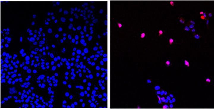 Hier sehen wir unbehandelte Krebszellen (links) und mit AOH1996 behandelte Krebszellen (rechts), die abgetötet wurden (violett)