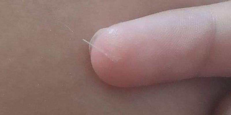 Eine Meeresschnecke sorgt am Strand von Jesolo für unangenehme Szenen.