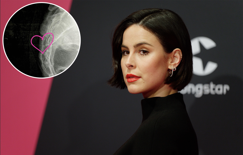 Lena Meyer-Landrut teilte ihr Röntgenbild auf Instagram.