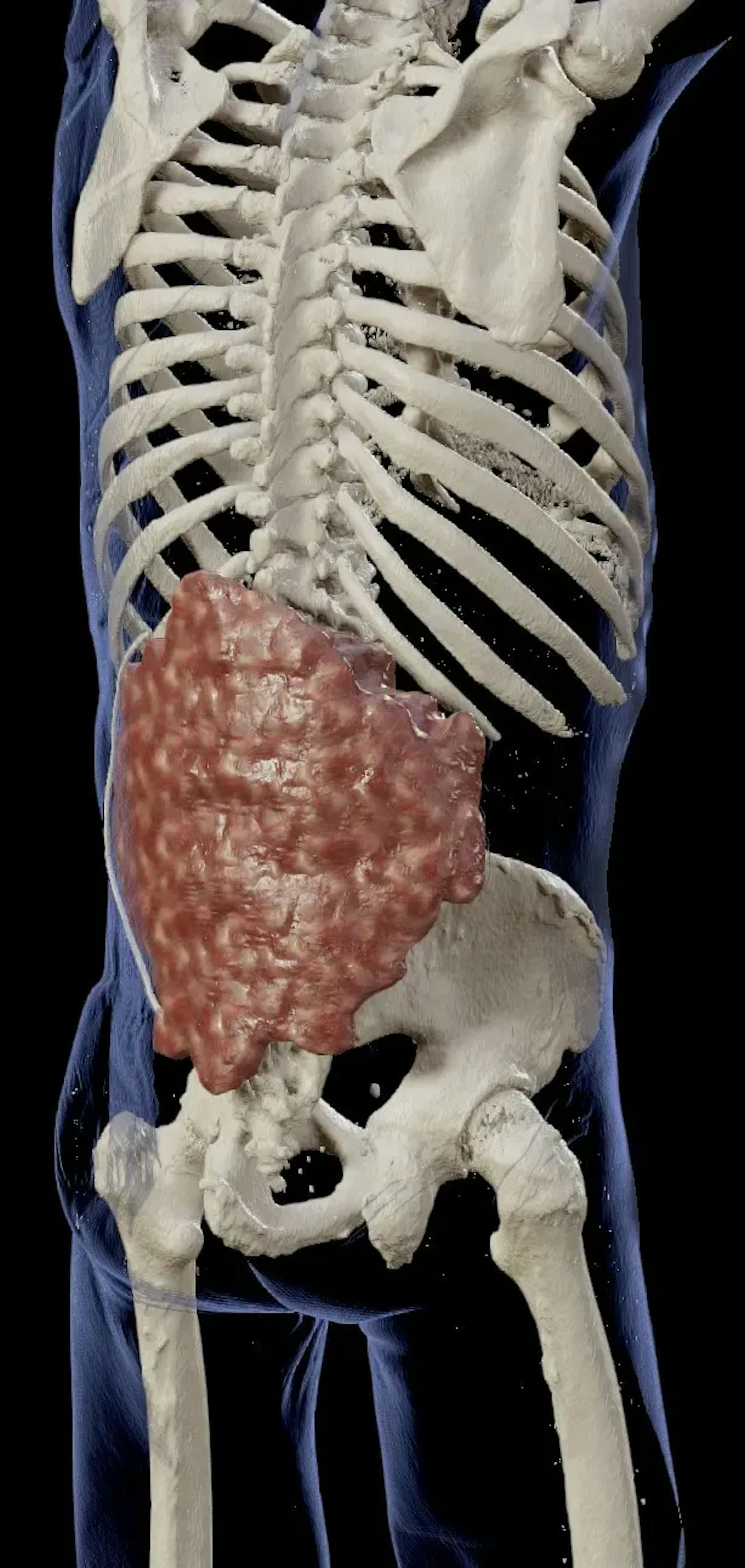 Der Tumor hatte bereits Teile der Wirbelsäule zersetzt und die Nerven gequetscht, sodass Lähmungen in den Beinen auftraten.