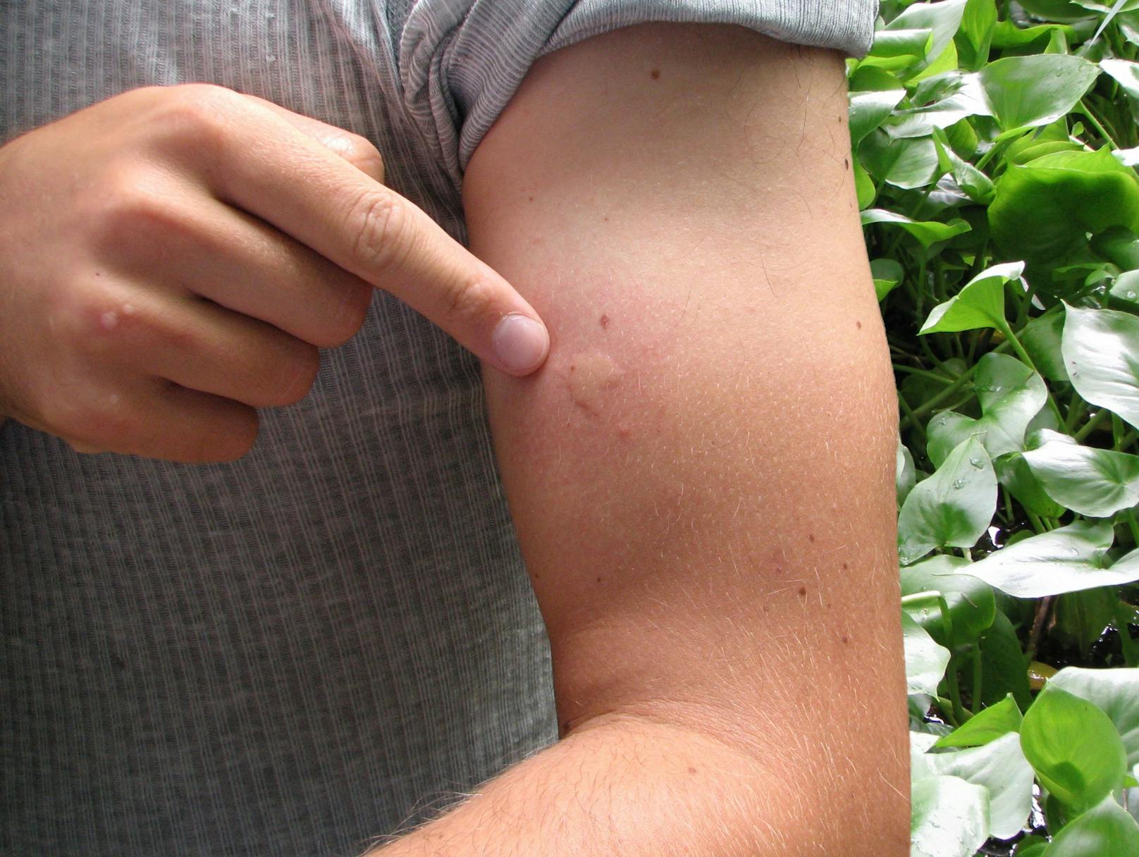 Die vielen Mücken sorgen für Quaddeln, Rötungen und Juckreiz.