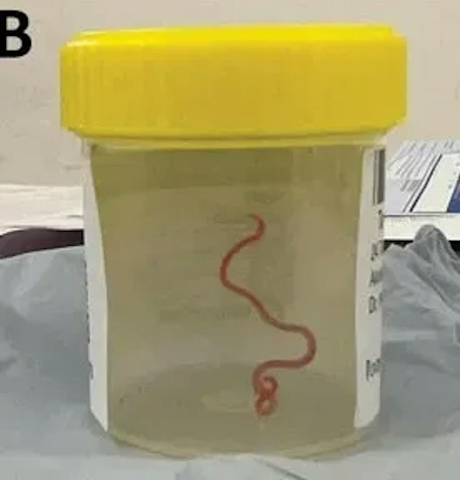 Die Mediziner schickten den lebenden Wurm in ein Forschungsinstitut. Dort erklärten die Wissenschaftler und Wissenschaftlerinnen, dass der Parasit normalerweise in Pythons vorkommt.