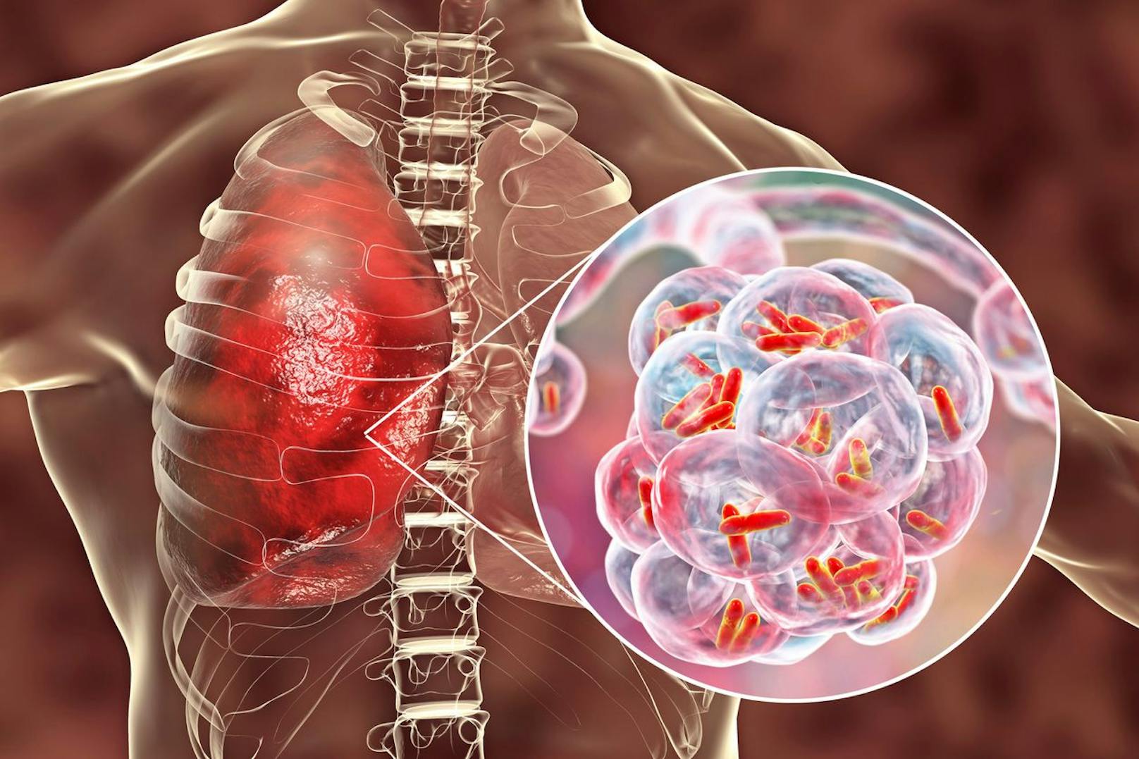 Durch Keuchhusten können gefährliche Bakterien in die Lunge geraten. (Symbolbild)