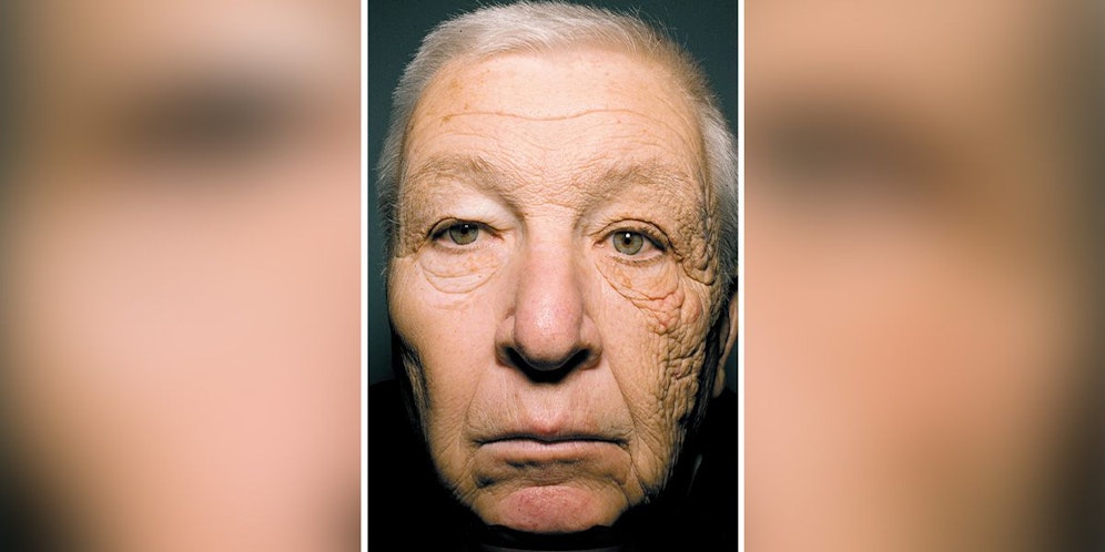 Eine erhöhte UV-Licht-Aufnahme dazu führt, dass sich die Kollagenfasern in der Haut dicht zusammenlagern, wodurch das Hautgewebe steifer wird und schwerer zu brechen ist. Dann spricht man von der 