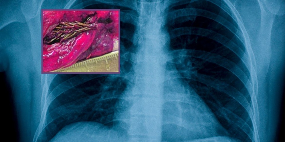 Diesen kleinen Tannenzweig (kl. Bild) fanden die Ärzte in der Lunge des Patienten.