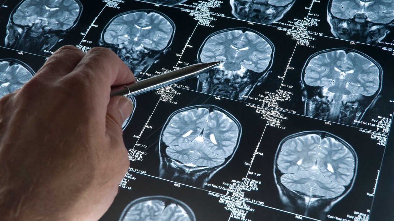 Heute.at - Menopause-Schockstudie: Das passiert mit Frauengehirn