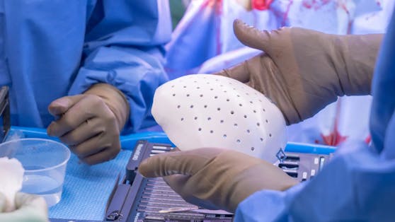Produziert wurde das Implantat (Bild) für einen 46-jährigen Mann, der im Jahr 2019 einen Schlaganfall erlitten hatte.