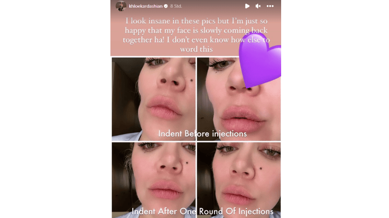 Der Vorher-Nachher-Vergleich: Khloés Delle im Gesicht ist deutlich aufgefüllter. 