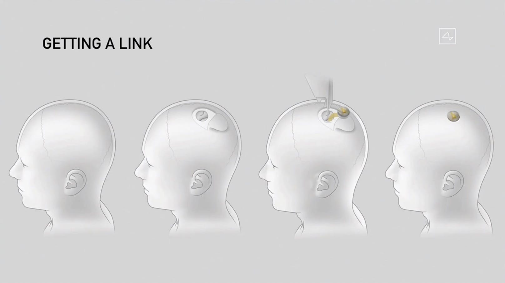 Das Implantat soll in die Hirnregion eingesetzt werden, die den Bewegungswillen steuert.