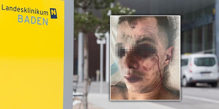 Opfer Andre (23) lebt nach Prügel-Attacke in Badner Szenelokal mit Metallplatte im Schädel.