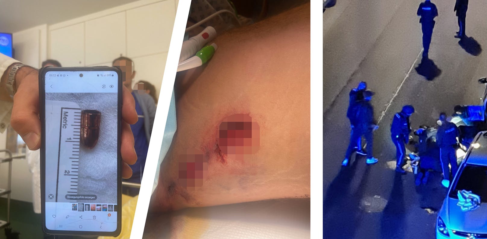 Die Kugel, die Ärzte aus dem Rücken eines der Opfer operierten. Schock-Fotos zeigen weitere Verletzungen der Schießerei in Wien-Floridsdorf.