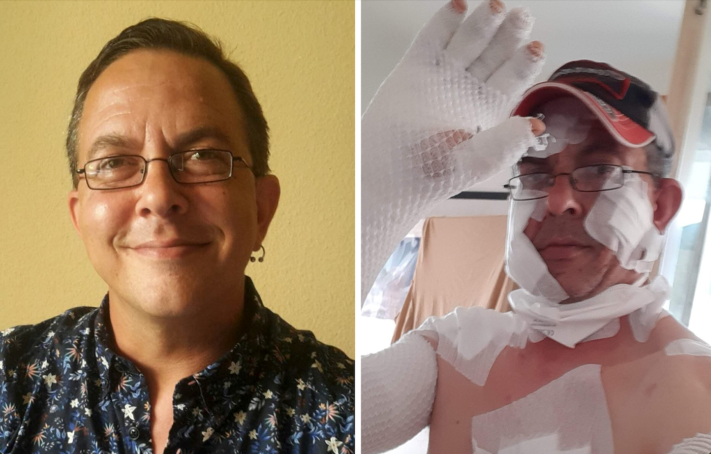 Bei Norbert B. (51) wurde eine äußerst seltene Hautkrankheit diagnostiziert, die schmerzhafte Wunden verursacht.