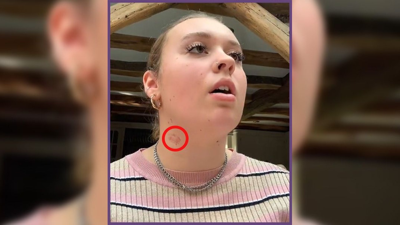 Heute.at - Dieses Muttermal macht Mollie zum Mobbing-Opfer