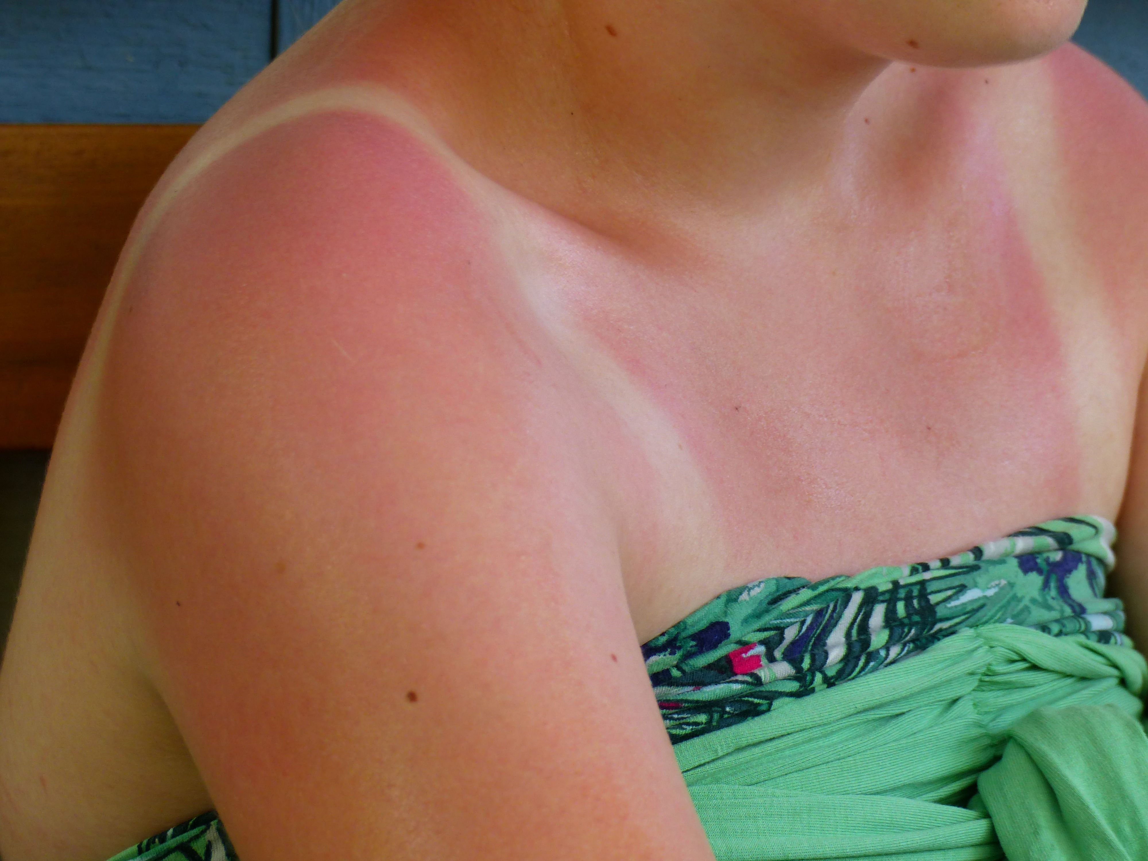 Eine synthetische Version von Melanin soll laut US-Forschern Hautschäden schneller heilen lassen.