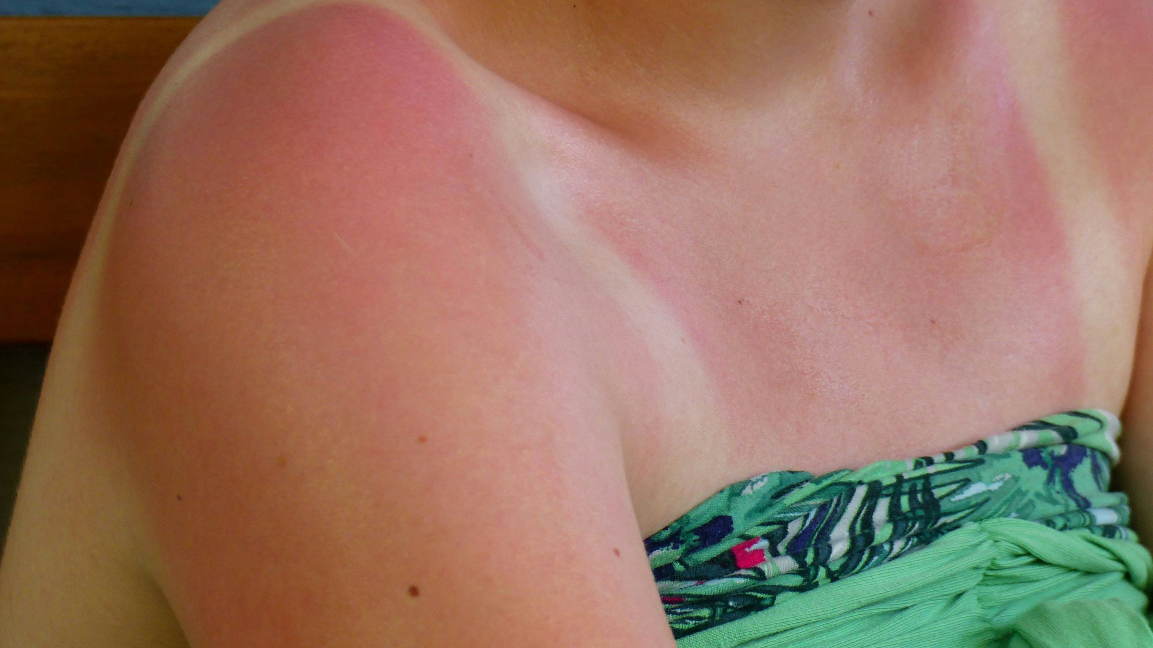 Download von www.picturedesk.com am 07.11.2023 (12:24).  Sonnenbrand, die Tücken des Sommers - 20150703_PD11628 - Rechteinfo: Rights Managed (RM)