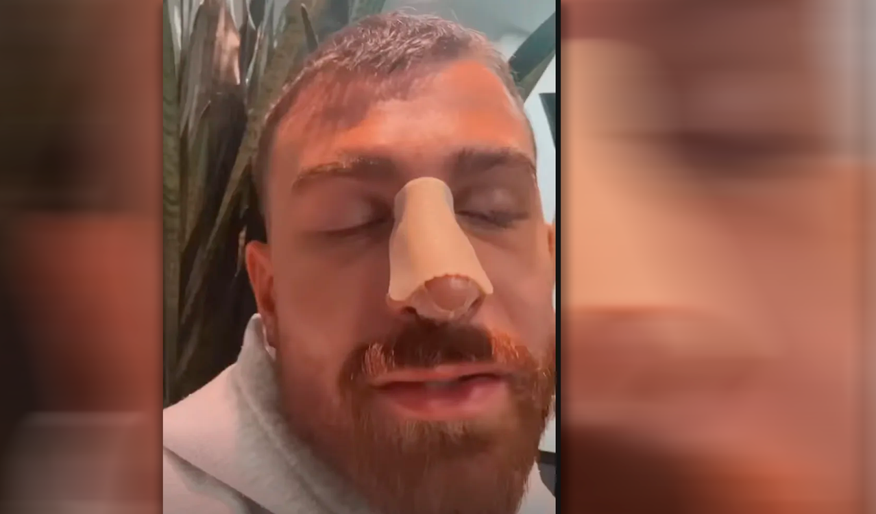 Gigi mit dickem Pflaster auf der Nase.