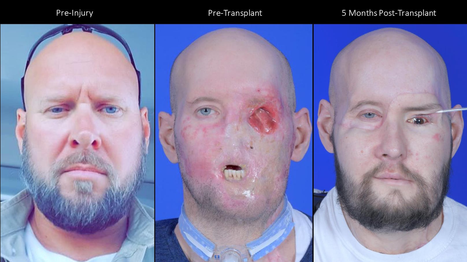 Ein Chirurgenteam der NYU Langone Health führte die weltweit erste Transplantation eines ganzen Auges und eines Teils des Gesichts bei Aaron James aus Hot Springs, Arkansas durch. Er überlebte einen tödlichen 7200-Volt-Stromschlag während seiner Arbeit als Hochspannungsmonteur im Juni 2021.