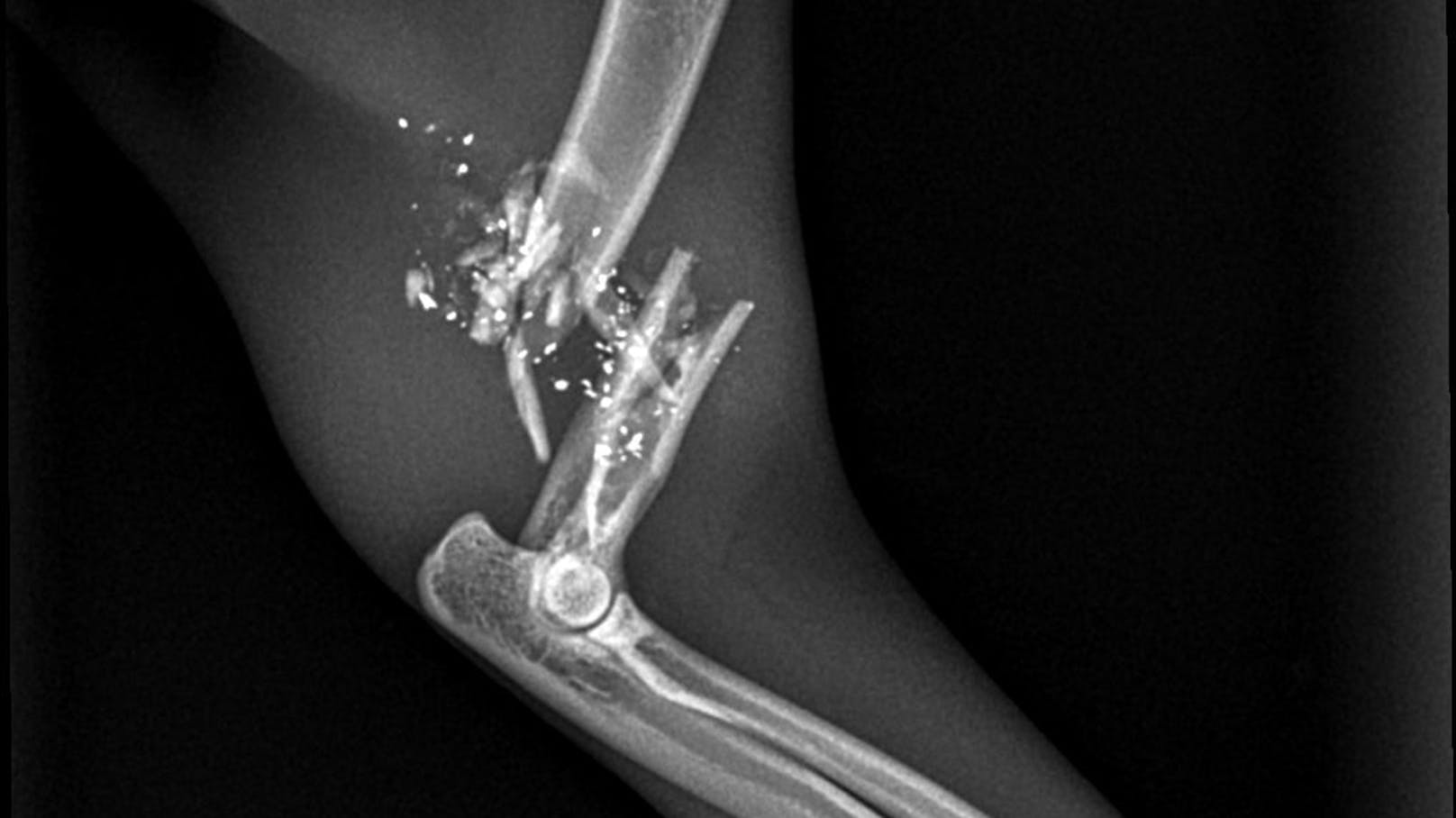 Das Röntgenbild des Arms zeigt einen völlig zerschmetterten Oberarm-Knochen.