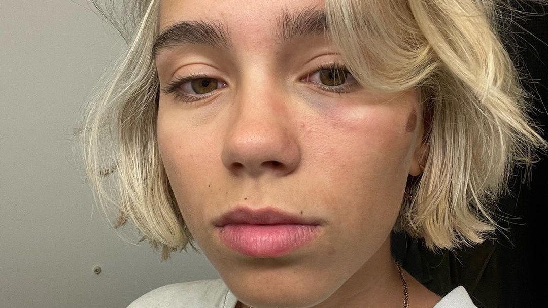 Lisa Mantler zeigt sich ihren Fans auf Instagram mit einem blauen Auge.