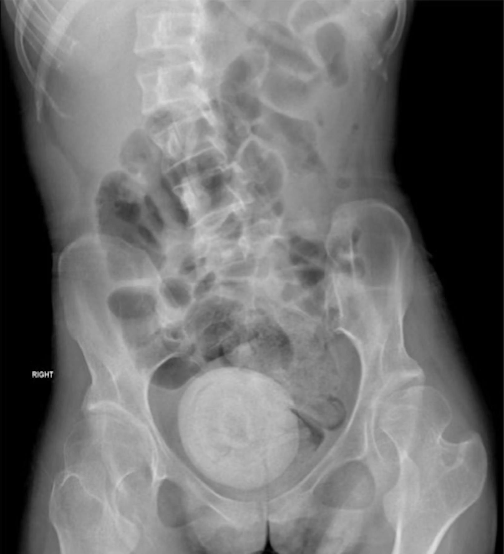 Das Röntgenbild zeigt den 9x10 cm großen Fremdkörper im Unterleib der Patientin.