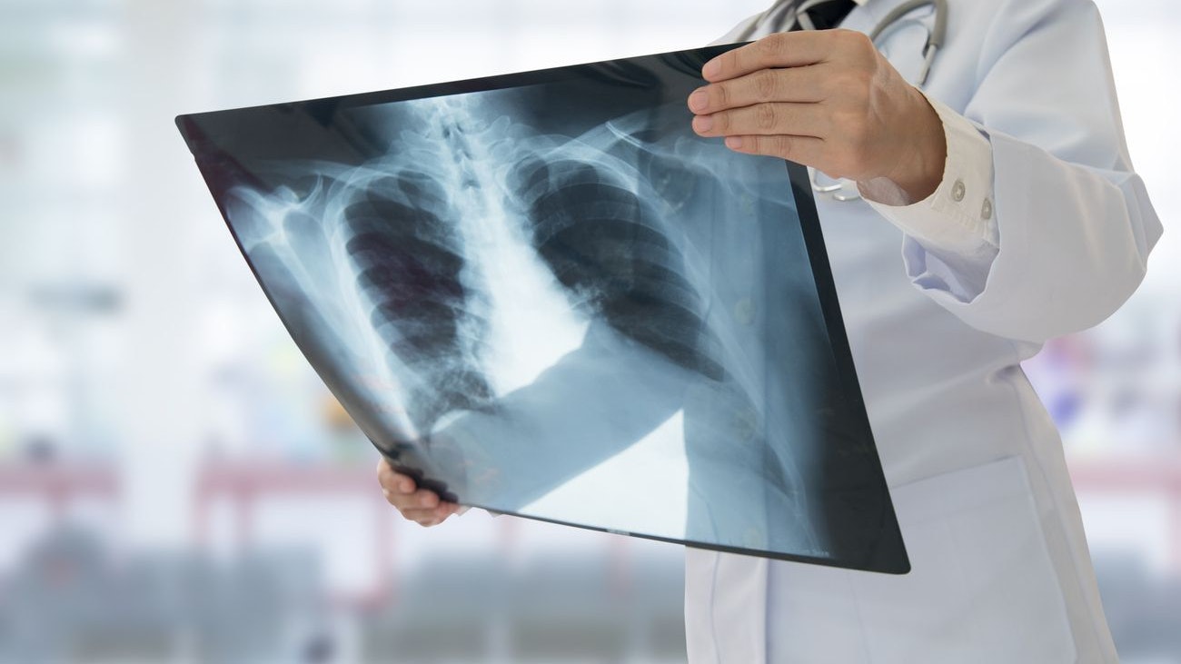 Doctor examining chest x-ray film of patient at hospital.