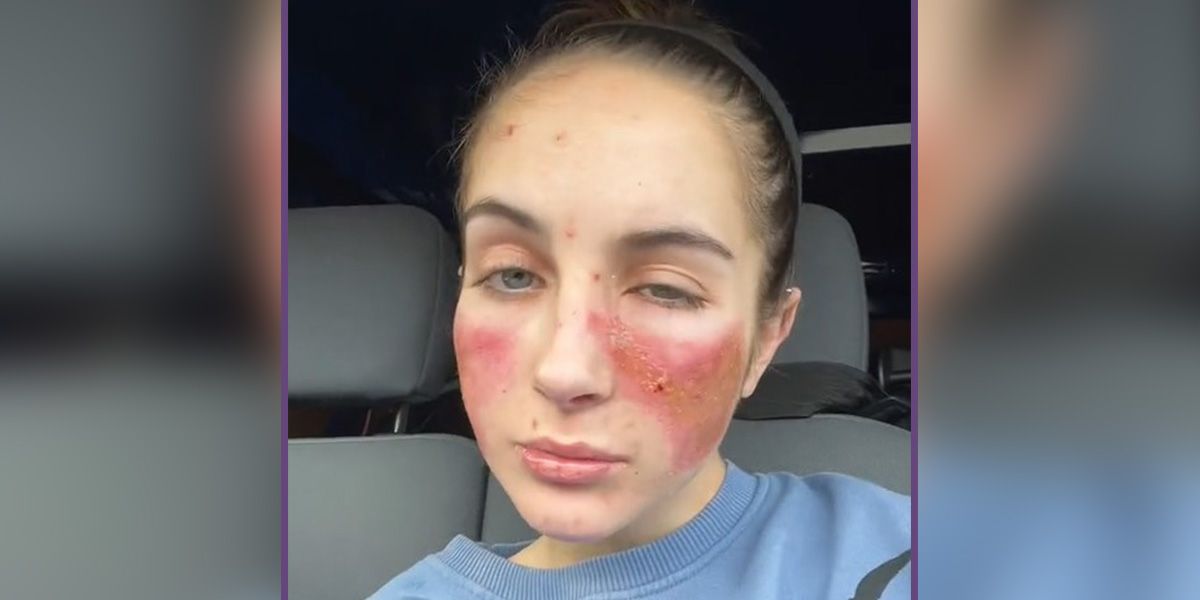 Beth Tsangarides (Bild) leidet seit 5 Jahren unter ihrem immer wieder kehrenden Ausschlag, der ihr Schmerzen bereitet.