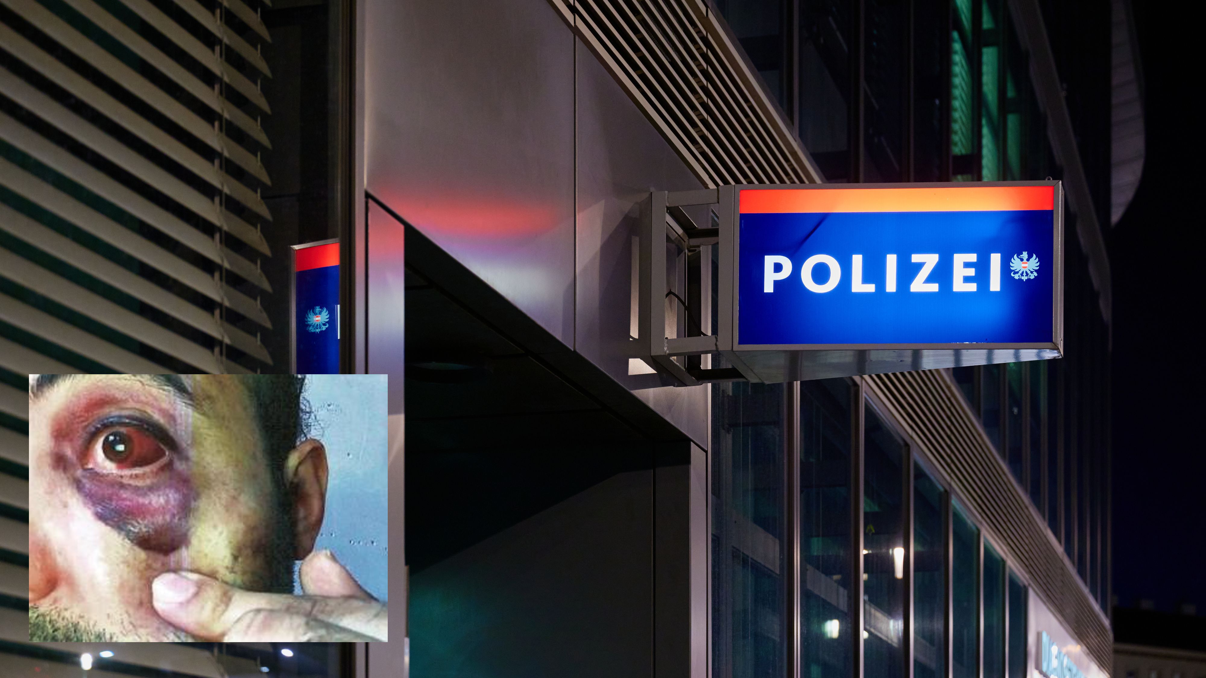 Blaues Auge nach Einvernahme auf Polizeistation in Wien. 