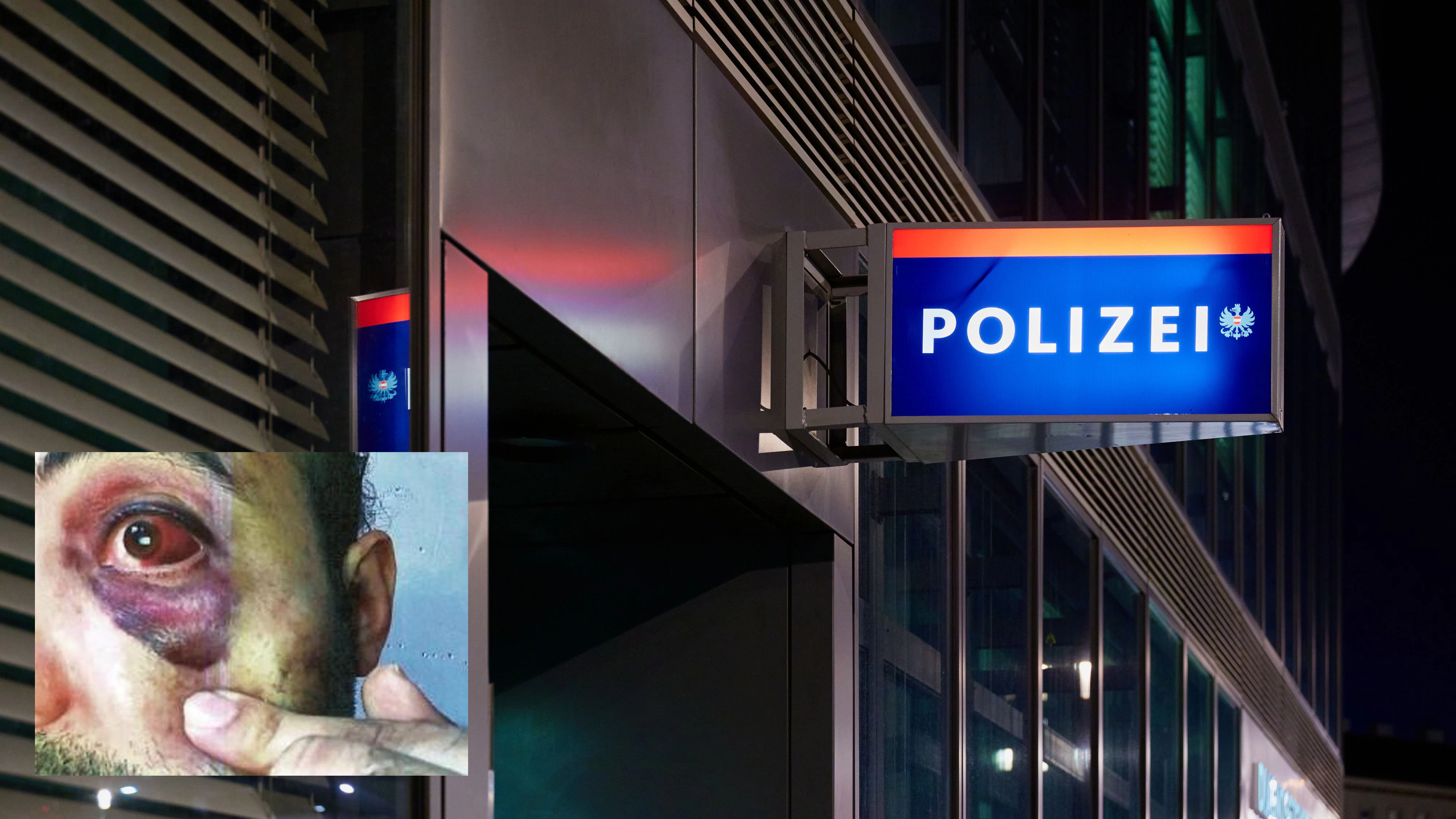 Blaues Auge nach Einvernahme auf Polizeistation in Wien. 