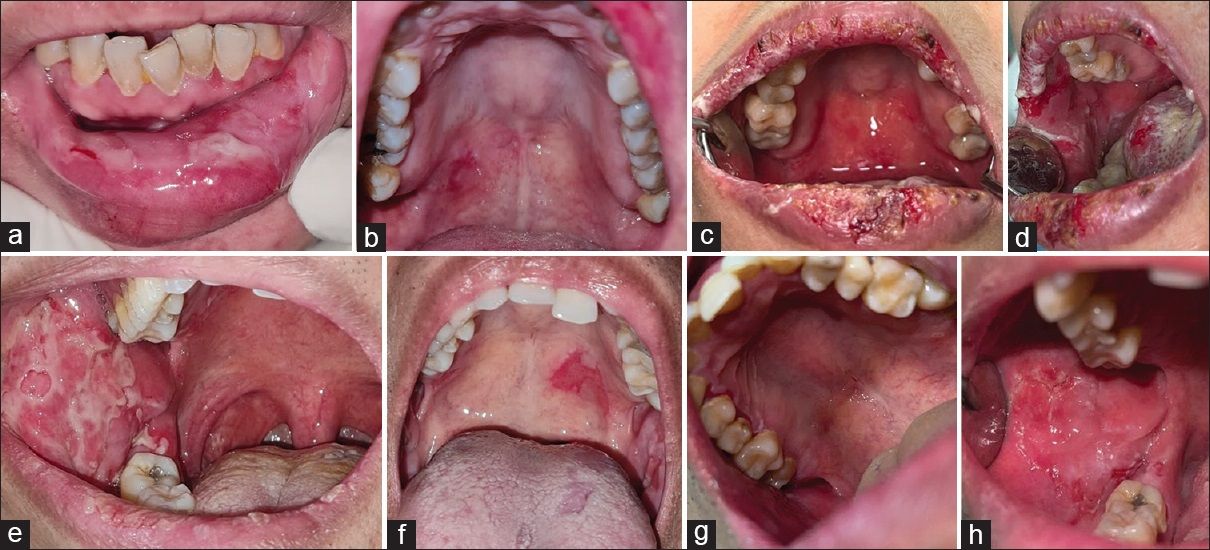 Pemphigus vulgaris (Bild) ist eine seltene schwere Autoimmunkrankheit, bei der sich unterschiedlich große Blasen auf der Haut, der Mundschleimhaut und anderen Schleimhäuten bilden.